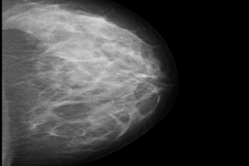 compare-mammogram