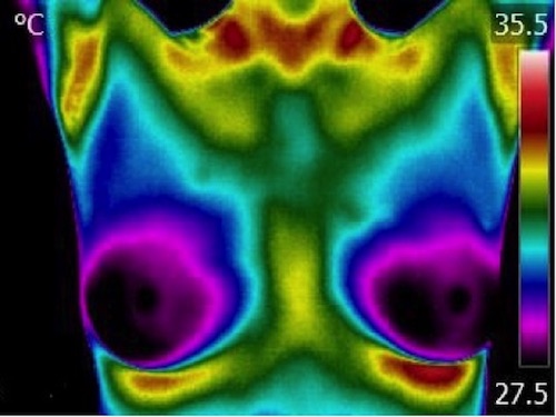 Breast Thermal Image in Rainbow colors